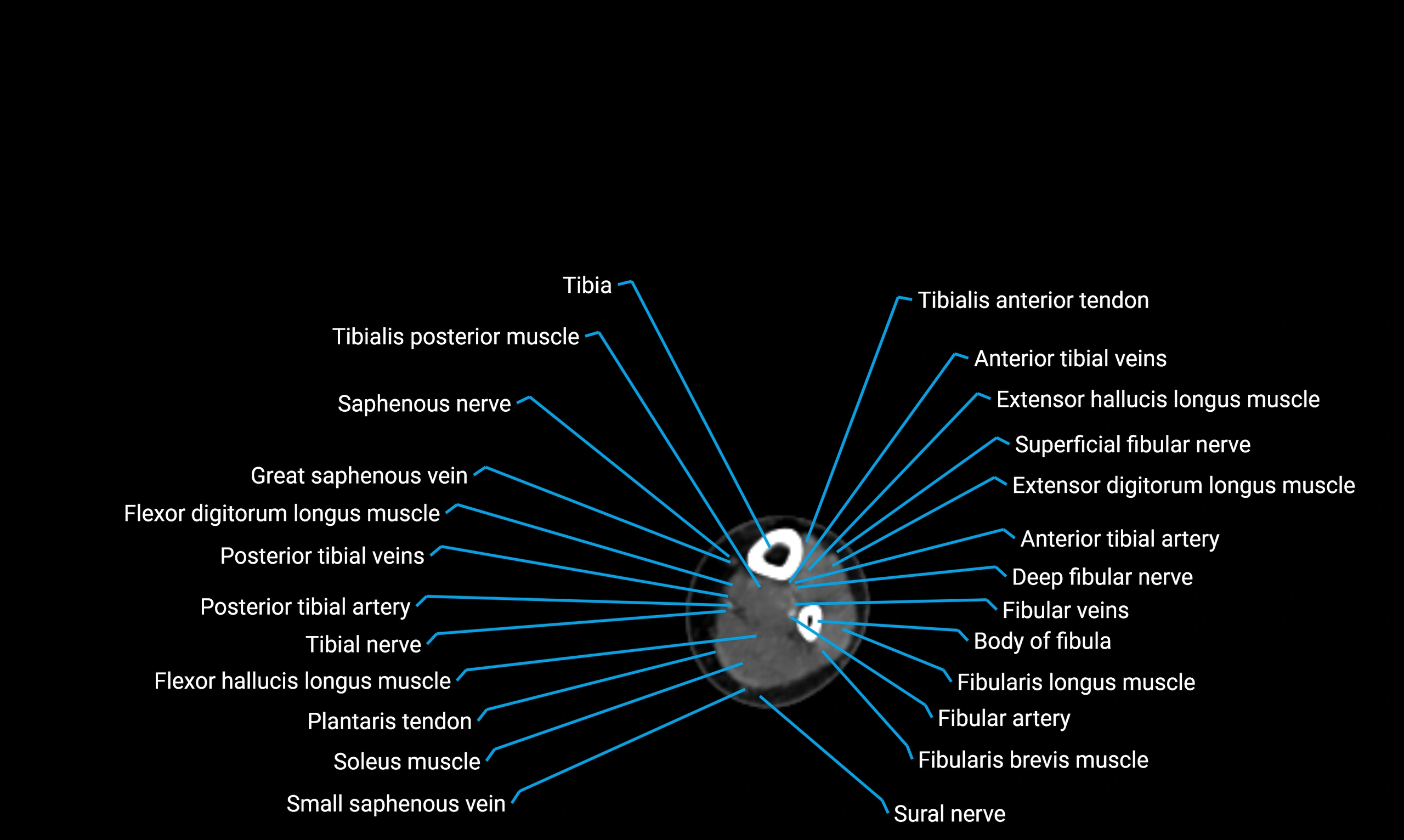 CT lower limb axial cross sectional anatomy labelled image 145 (2).webp